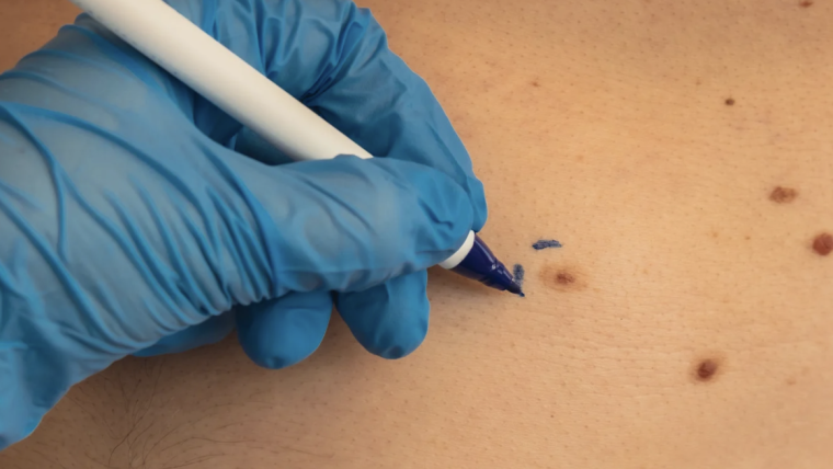 Skin Cancer Screening Appointment Near Fairfax, Virginia